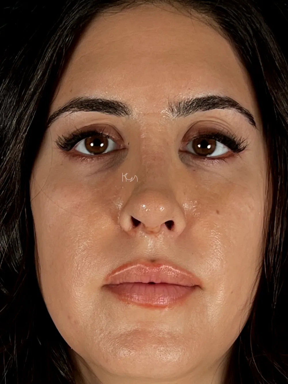 Après: Rhinoplastie de révision · Face · Une semaine après l’intervention