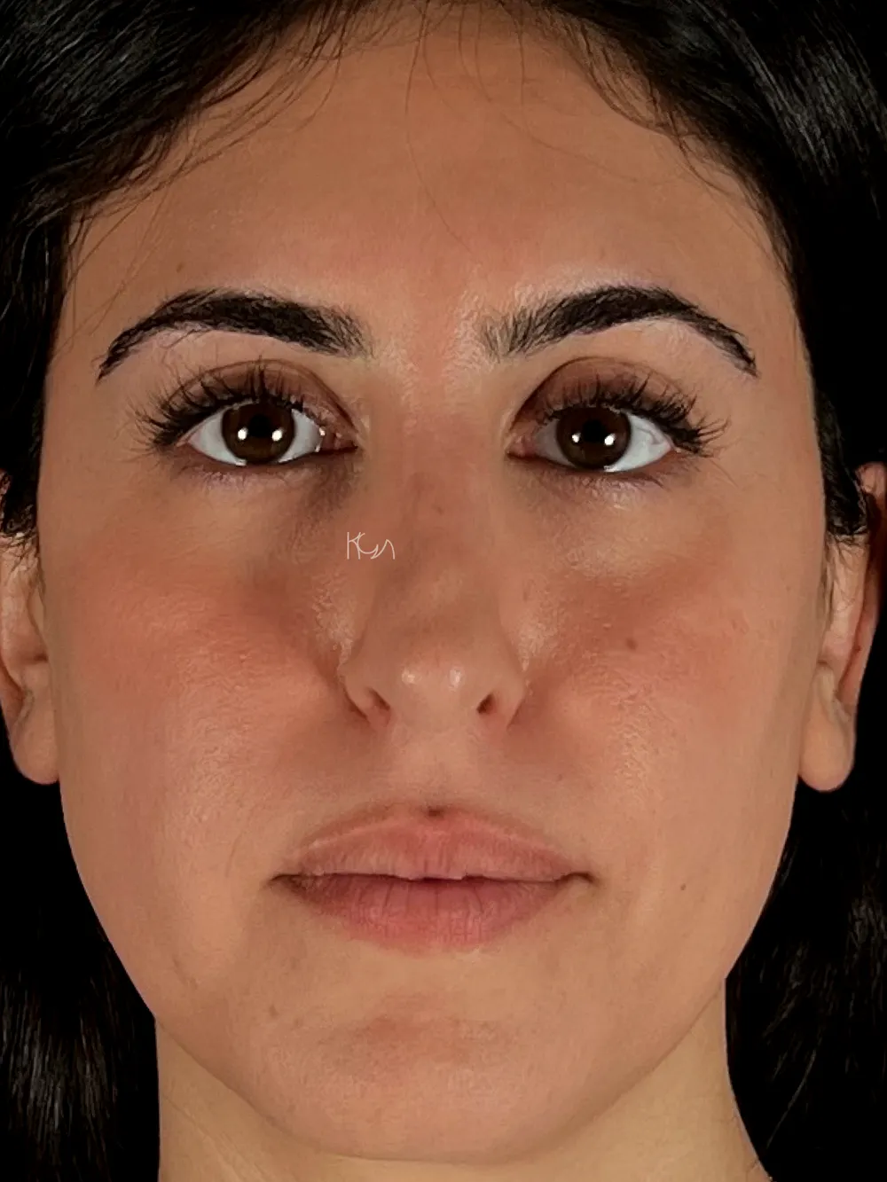 Avant: Rhinoplastie de révision · Face · Une semaine après l’intervention