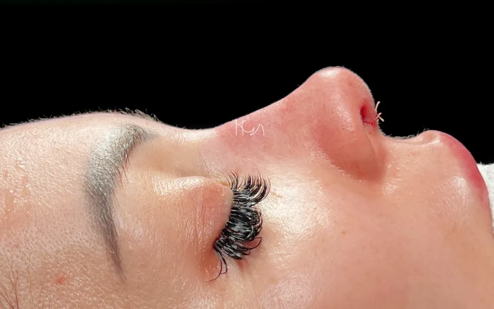 Après: Rhinoplastie primaire · Autre profil · Début de récupération