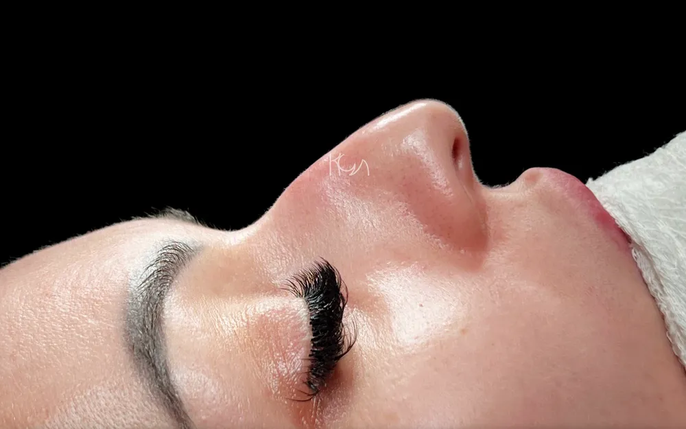Avant: Rhinoplastie primaire · Autre profil · Début de récupération
