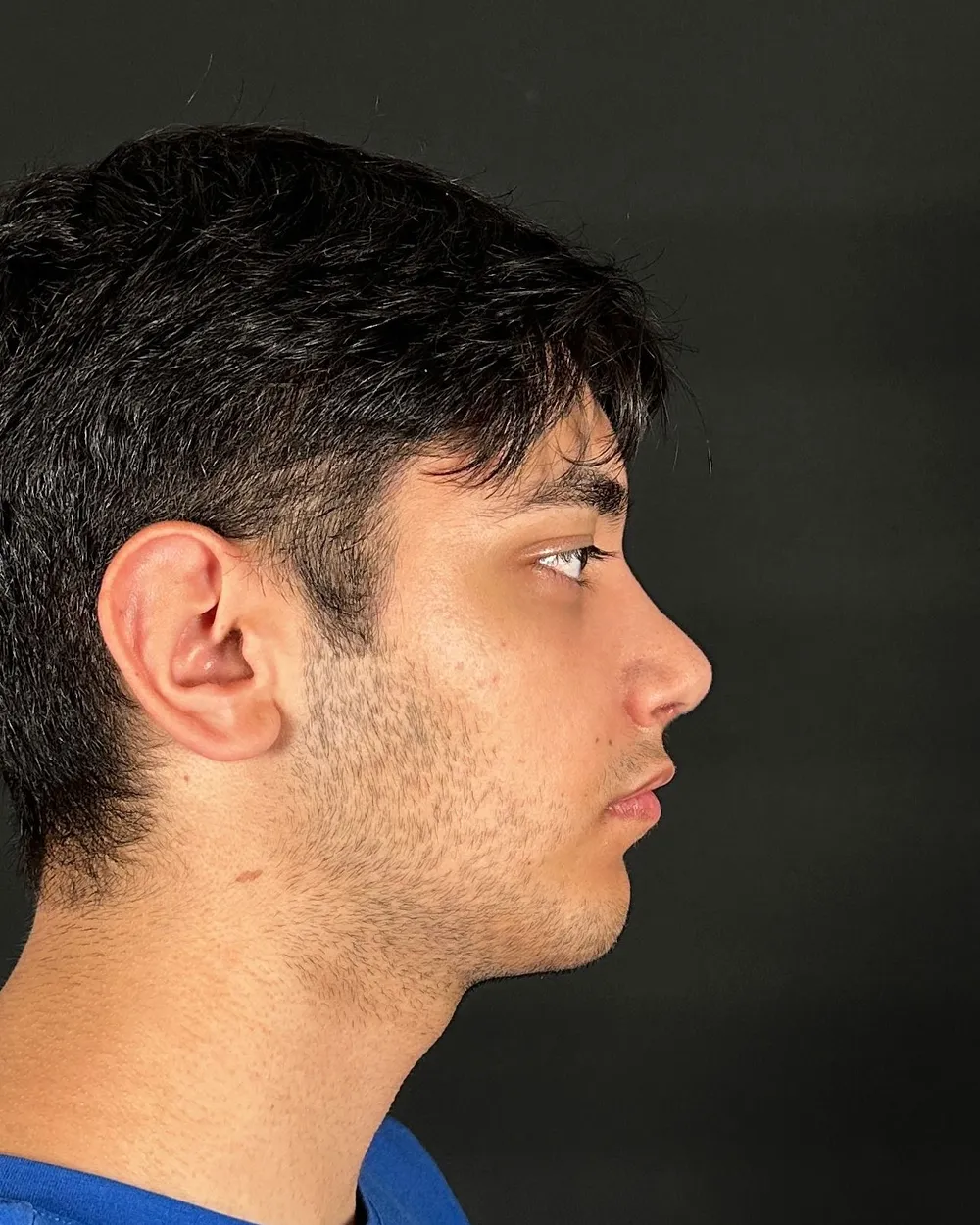 Sonrası: Primer rinoplasti, Profil