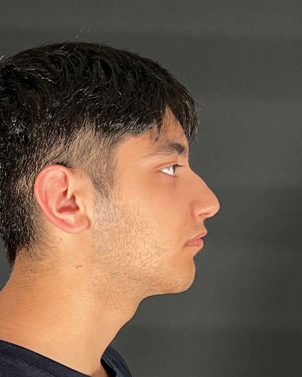 Öncesi: Primer rinoplasti, Profil