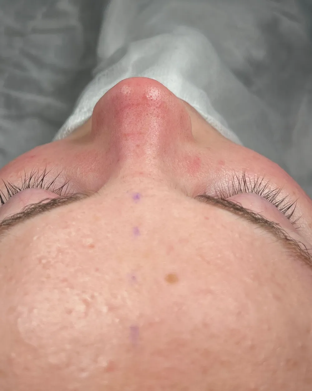 Après: Rhinoplastie primaire · Base · À la fin de l’opération, vue de dessous