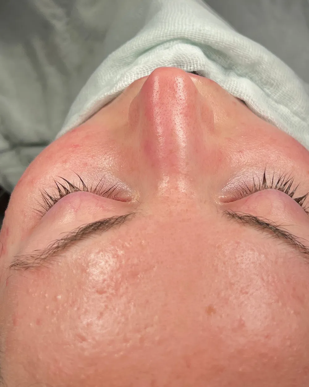 Avant: Rhinoplastie primaire · Base · À la fin de l’opération, vue de dessous