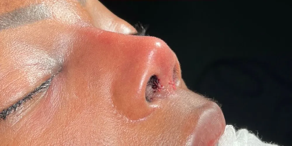 Après: Rhinoplastie ethnique · Trois-quarts · À la fin de l’opération