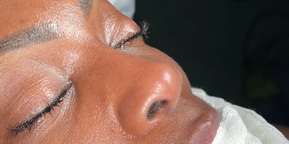 Avant: Rhinoplastie ethnique · Trois-quarts · À la fin de l’opération