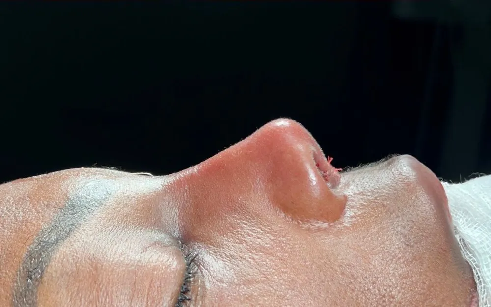 Nachher: Ethnische Rhinoplastik · Profil