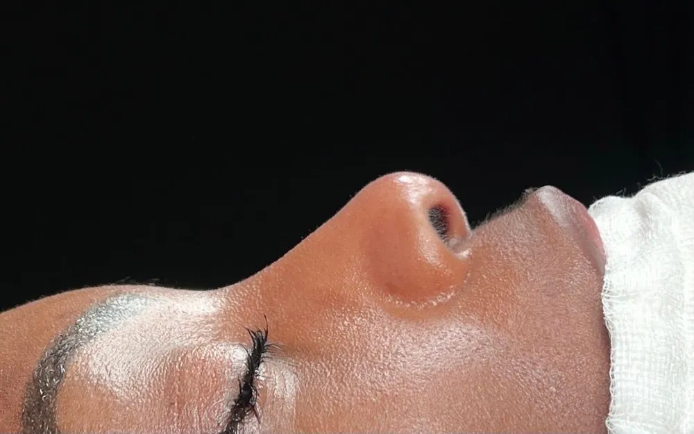 Vorher: Ethnische Rhinoplastik · Profil